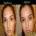 Get Rid Of Acne