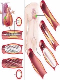 Angioplasty mobile app for free download