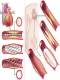 Angioplasty