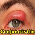 Conjunctivitis