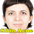 Skin Acne mobile app for free download