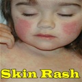 Skin Rash