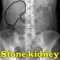 Stone kidney mobile app for free download