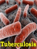 Tuberculosis